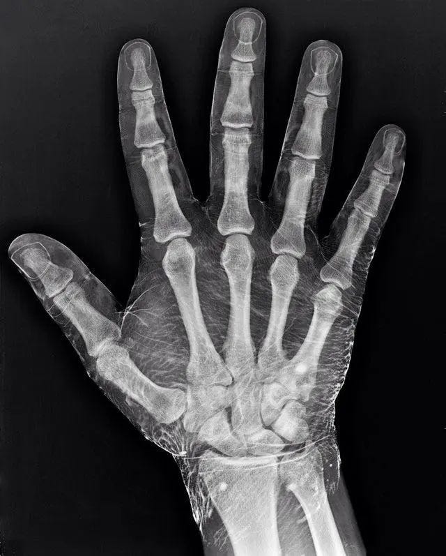 X-ray outline of skin around bones