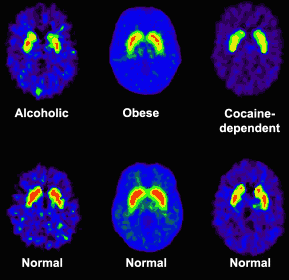 Brain scans showing dopamine activity related to addiction