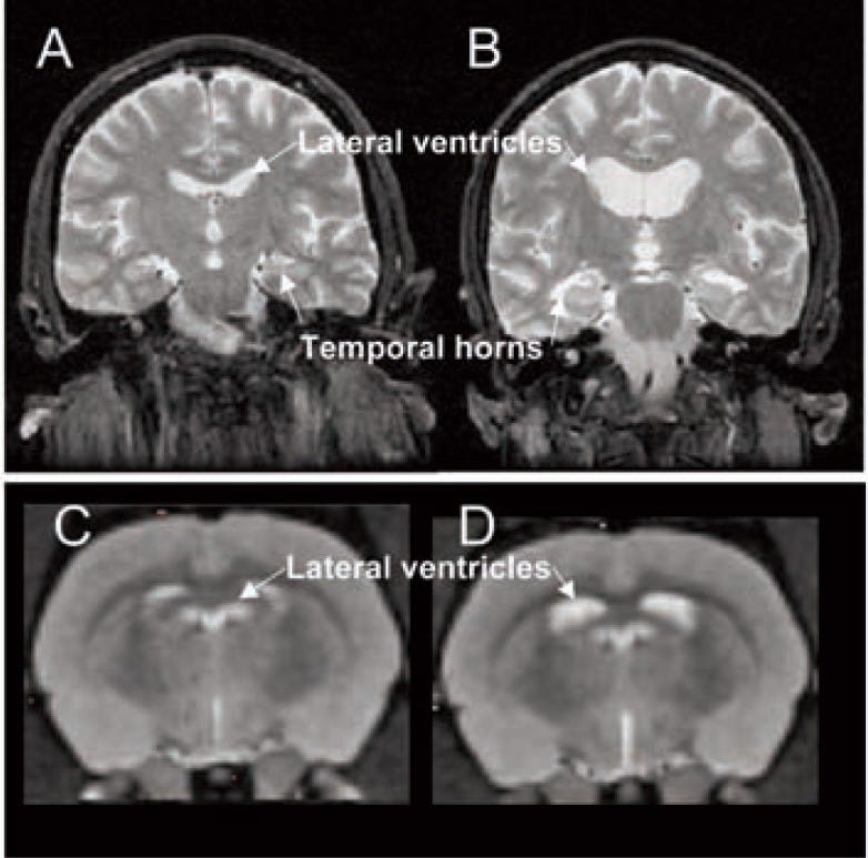 MRI images comparing brains of alcoholics and non-alcoholics