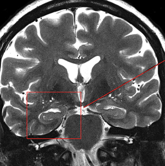 MRI showing effects of sedentary lifestyle on the brain